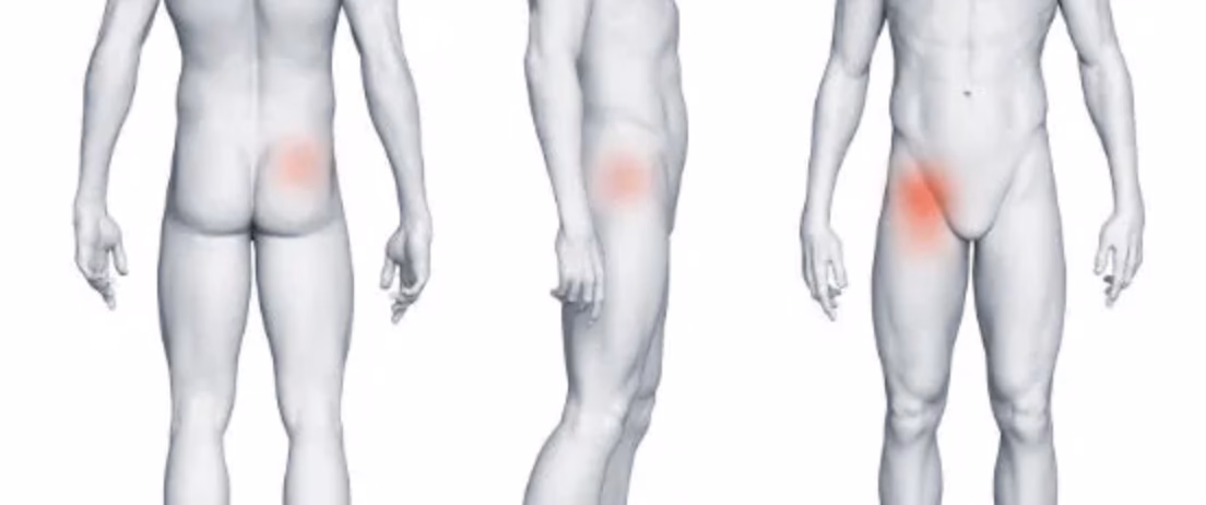 Hvordan føles en betændt slimsæk i hoften?